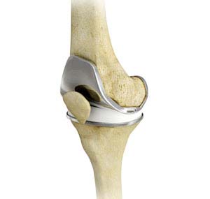 Total Knee Replacement / Total Knee Arthroplasty