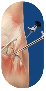 Anterior Total Hip Replacement for AVN Image