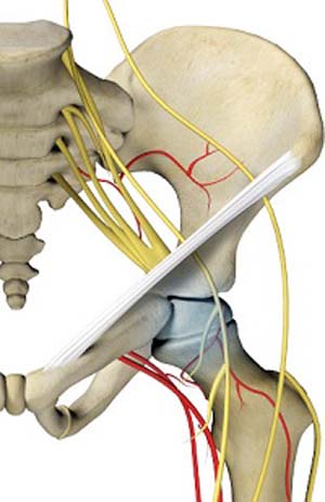 Hip Avascular Necrosis