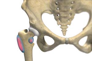 Trochanteric Bursitis