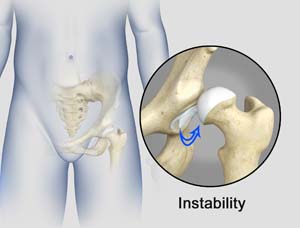 Hip instability