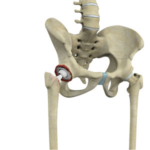 Revision Total Hip Replacement Seattle, WA