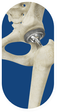 Happy Sailing after Anterior Total Hip Arthroplasty Image